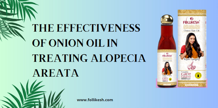 Onion Oil in Treating Alopecia